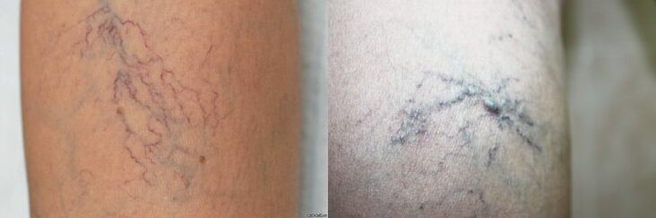 Síntomas de varices