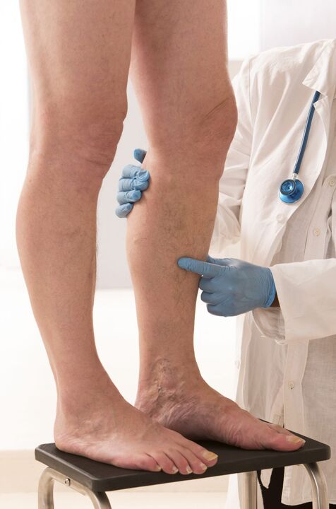 Varices que é