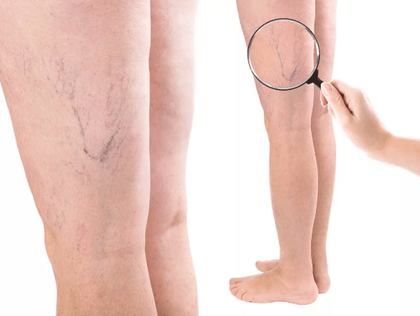 Veinas varices nas mulleres