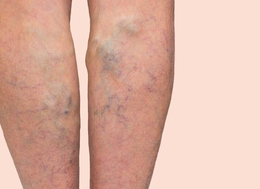 Como se ven varices