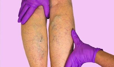 Que se pode e non se pode facer con varices