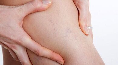 Signos e síntomas de varices
