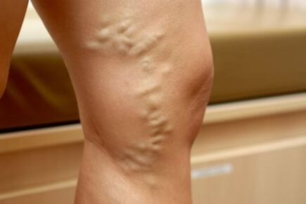 Medicamento para varices